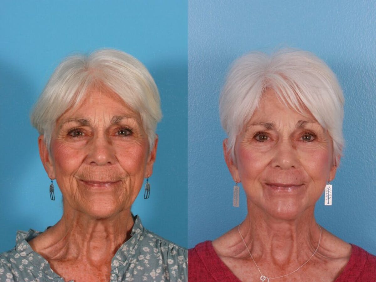 TCA Peel / Dermabrasion Before & After Gallery - Patient 292619 - Image 1