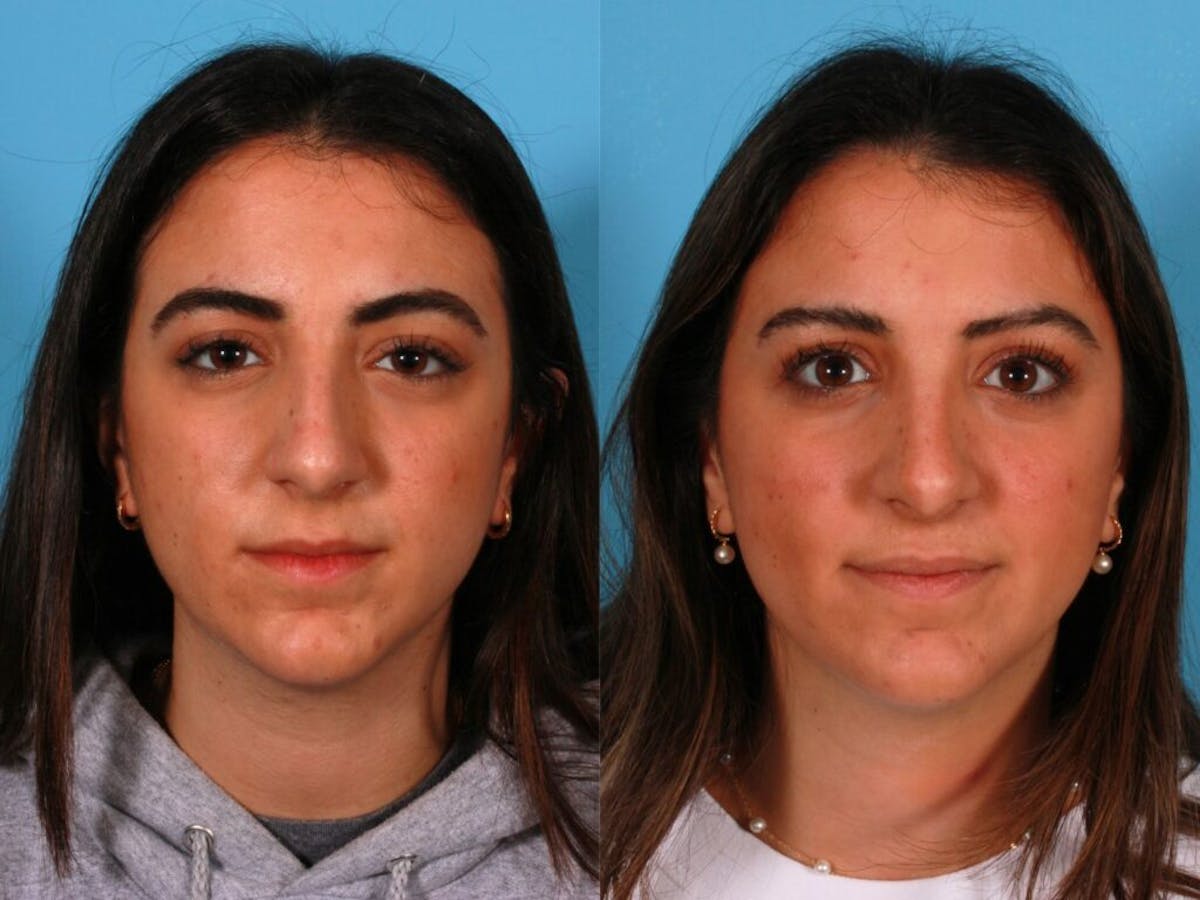 Rhinoplasty Before & After Gallery - Patient 297327 - Image 1