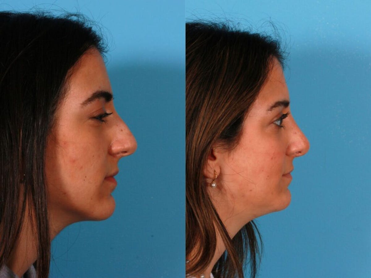 Rhinoplasty Before & After Gallery - Patient 297327 - Image 2