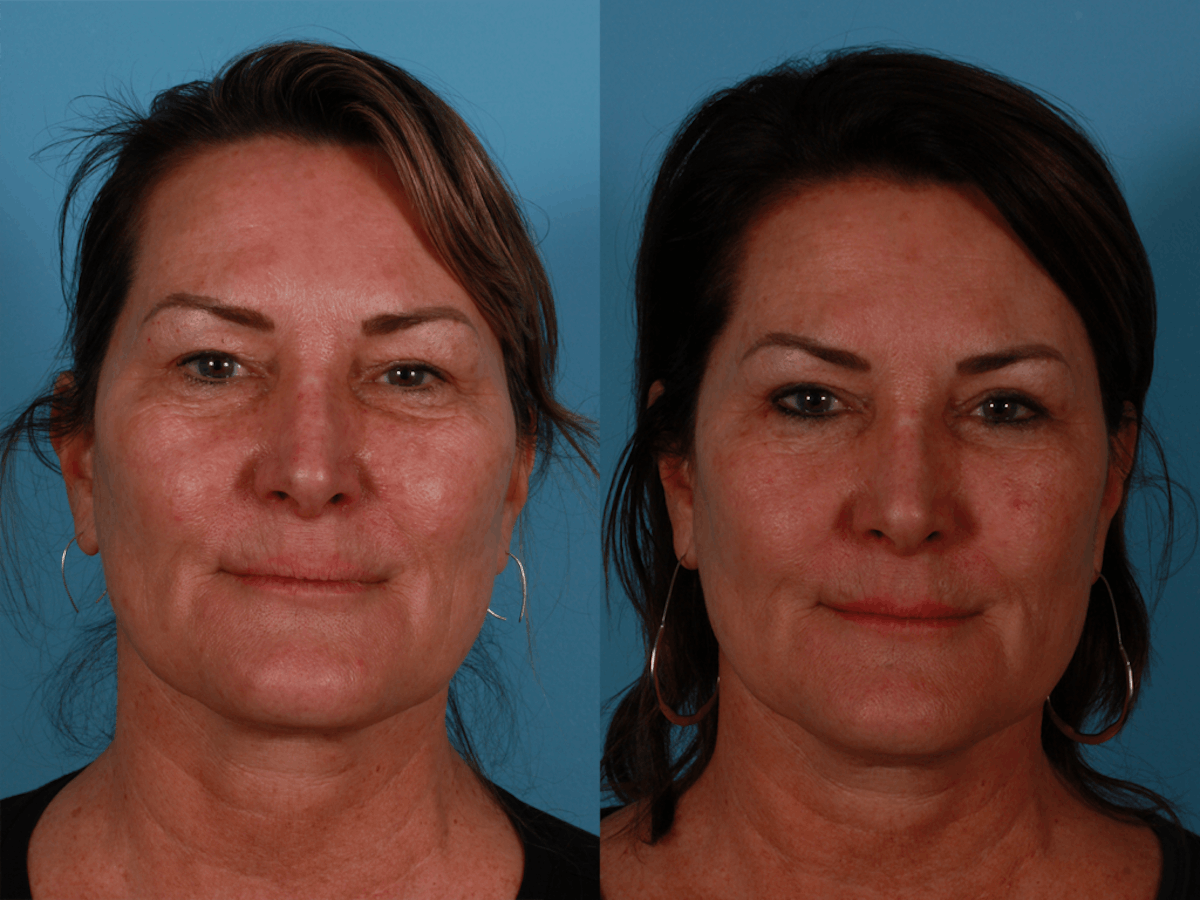 TCA Peel / Dermabrasion Before & After Gallery - Patient 198571 - Image 1