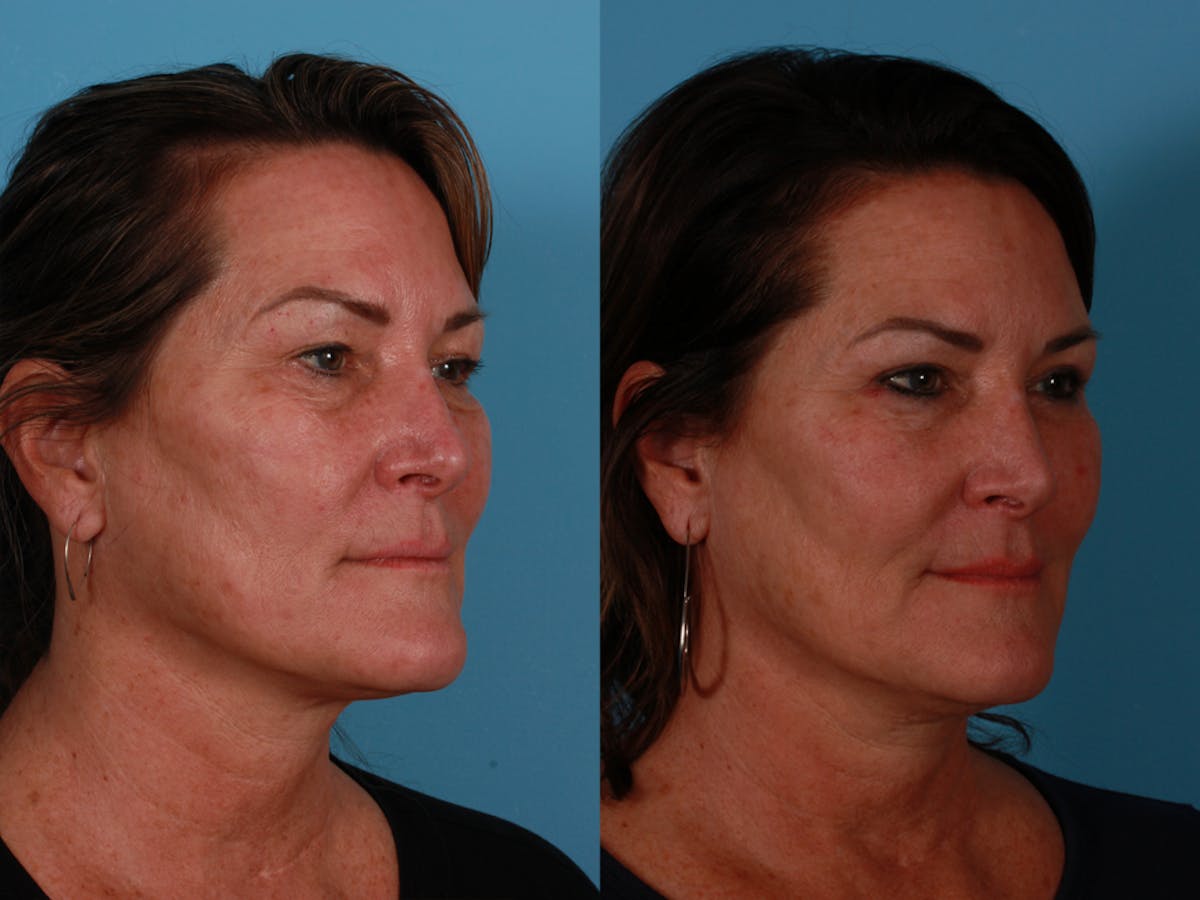 TCA Peel / Dermabrasion Before & After Gallery - Patient 198571 - Image 2