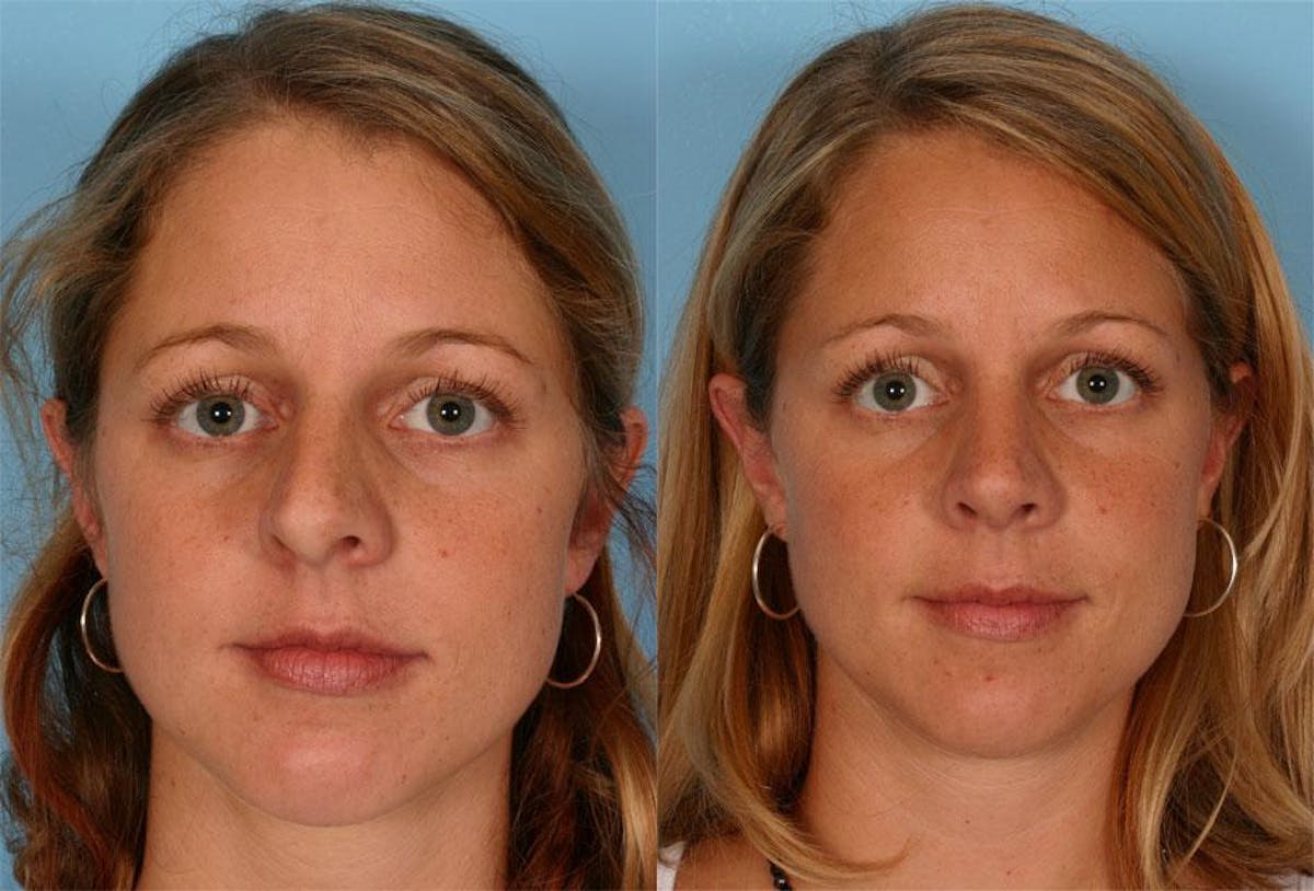 Rhinoplasty Before & After Gallery - Patient 413271 - Image 1
