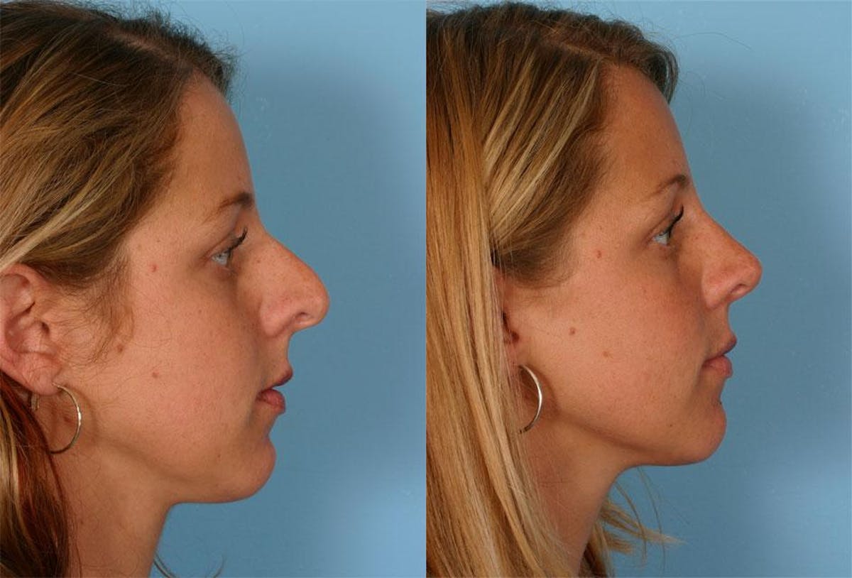 Rhinoplasty Before & After Gallery - Patient 413271 - Image 2
