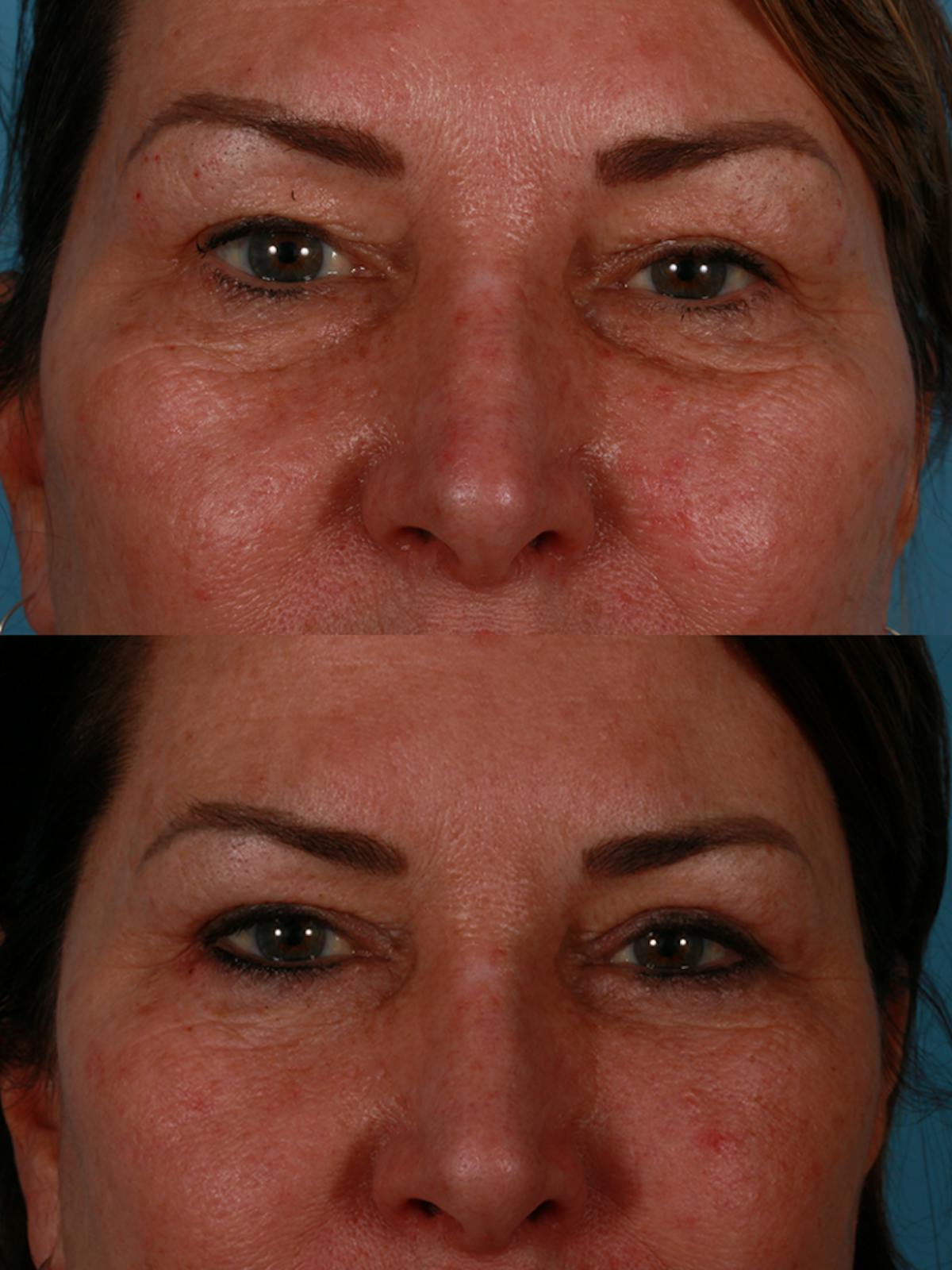 TCA Peel / Dermabrasion Before & After Gallery - Patient 198571 - Image 3