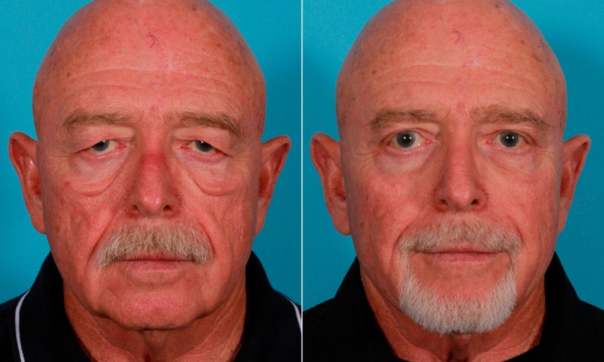 Eyelid Surgery (Blepharoplasty) Before & After Gallery - Patient 352426 - Image 1