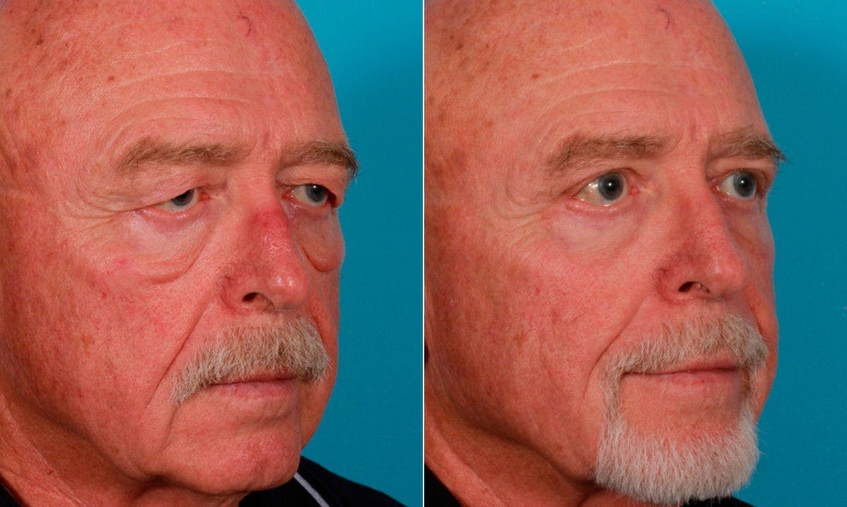 Eyelid Surgery (Blepharoplasty) Before & After Gallery - Patient 352426 - Image 2