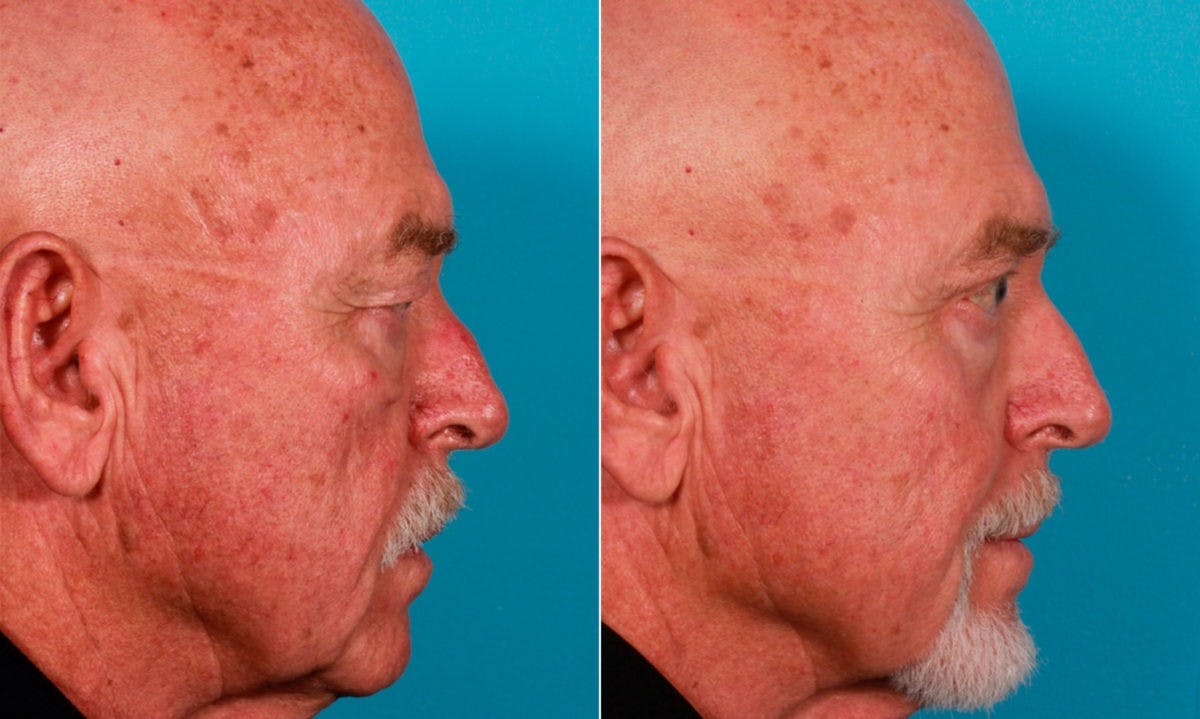 Eyelid Surgery (Blepharoplasty) Before & After Gallery - Patient 352426 - Image 3