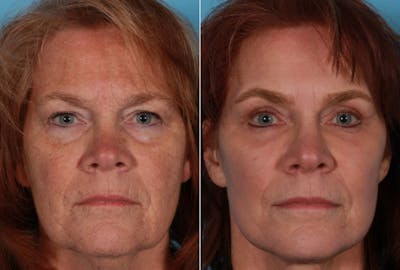 Eyelid Surgery (Blepharoplasty) Before & After Gallery - Patient 347928 - Image 1