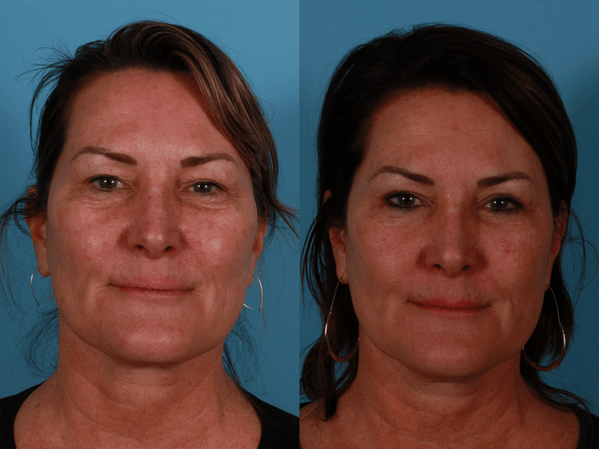 Eyelid Surgery (Blepharoplasty) Before & After Gallery - Patient 275481 - Image 1