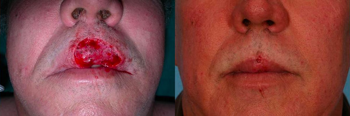 Skin Cancer Before & After Gallery - Patient 173970 - Image 1