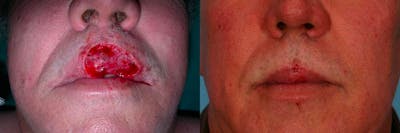 Skin Cancer Before & After Gallery - Patient 173970 - Image 1
