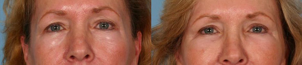 Eyelid Surgery (Blepharoplasty) Before & After Gallery - Patient 387661 - Image 1