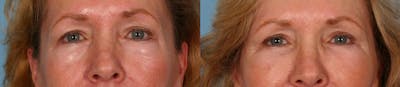 Eyelid Surgery (Blepharoplasty) Before & After Gallery - Patient 387661 - Image 1