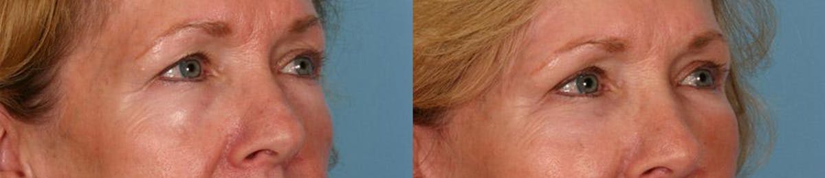 Eyelid Surgery (Blepharoplasty) Before & After Gallery - Patient 387661 - Image 2
