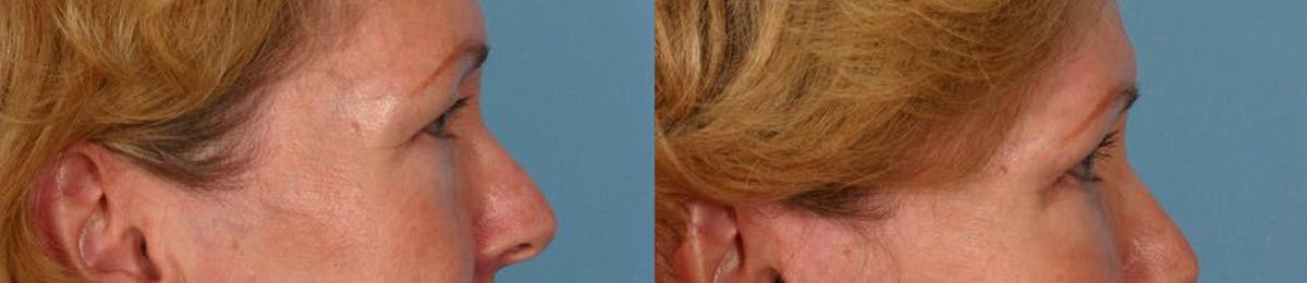 Eyelid Surgery (Blepharoplasty) Before & After Gallery - Patient 387661 - Image 3