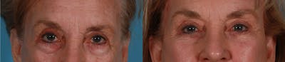 Eyelid Surgery (Blepharoplasty) Before & After Gallery - Patient 388792 - Image 1