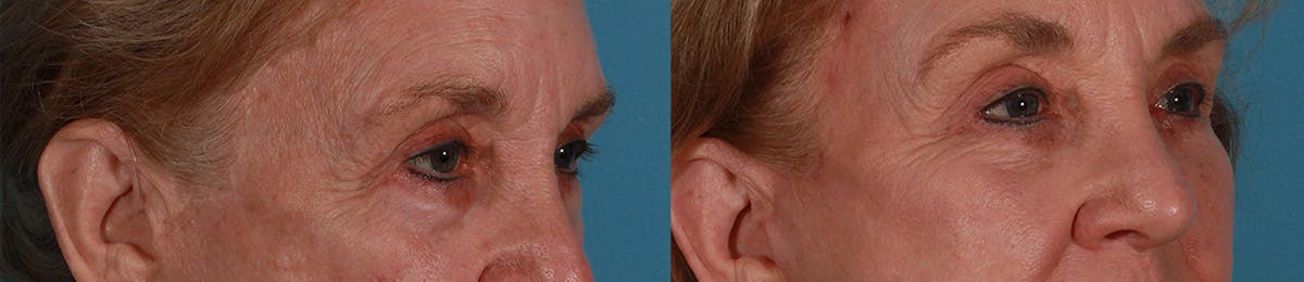 Eyelid Surgery (Blepharoplasty) Before & After Gallery - Patient 388792 - Image 2