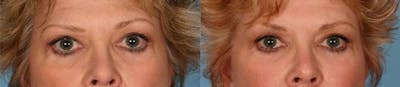 Eyelid Surgery (Blepharoplasty) Before & After Gallery - Patient 433134 - Image 1