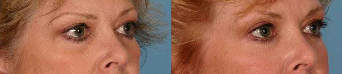 Eyelid Surgery (Blepharoplasty) Before & After Gallery - Patient 433134 - Image 2