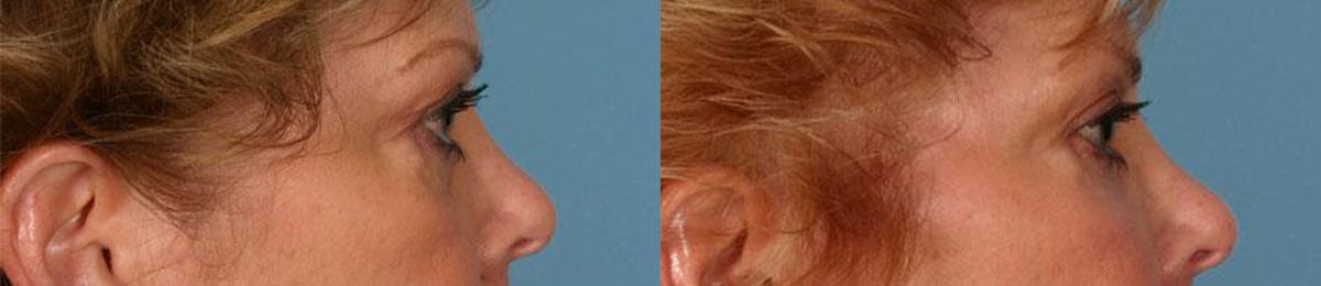 Eyelid Surgery (Blepharoplasty) Before & After Gallery - Patient 433134 - Image 3
