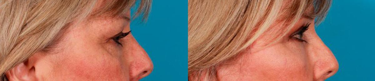 Eyelid Surgery (Blepharoplasty) Before & After Gallery - Patient 371690 - Image 3
