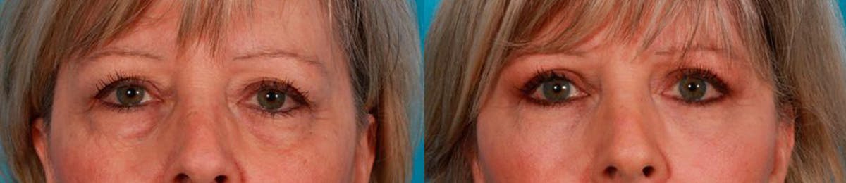 Eyelid Surgery (Blepharoplasty) Before & After Gallery - Patient 371690 - Image 1