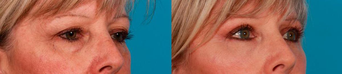 Eyelid Surgery (Blepharoplasty) Before & After Gallery - Patient 371690 - Image 2