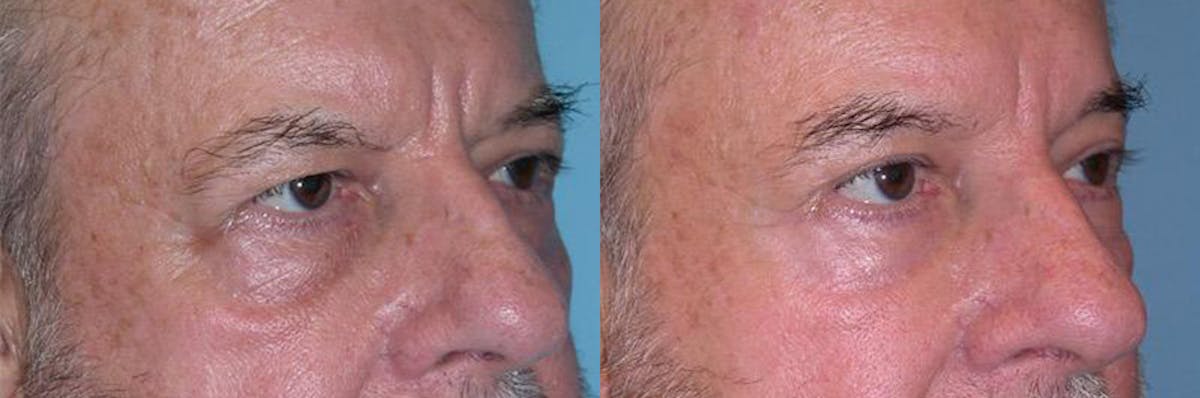 Eyelid Surgery (Blepharoplasty) Before & After Gallery - Patient 289617 - Image 2