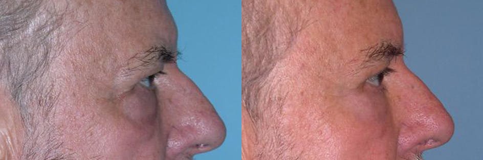 Eyelid Surgery (Blepharoplasty) Before & After Gallery - Patient 289617 - Image 3