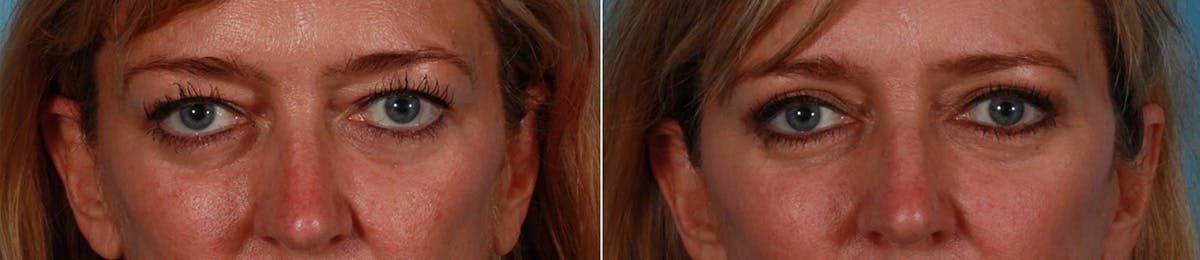 Eyelid Surgery (Blepharoplasty) Before & After Gallery - Patient 232220 - Image 1