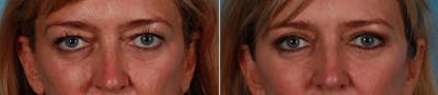 Eyelid Surgery (Blepharoplasty) Before & After Gallery - Patient 232220 - Image 1