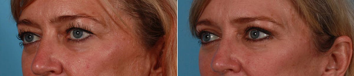 Eyelid Surgery (Blepharoplasty) Before & After Gallery - Patient 232220 - Image 2