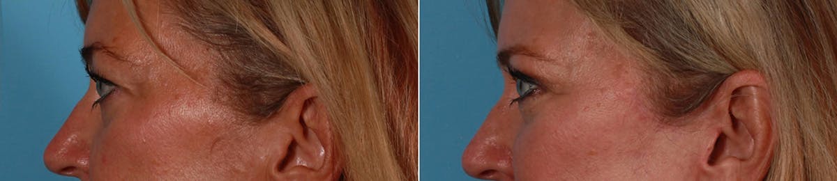 Eyelid Surgery (Blepharoplasty) Before & After Gallery - Patient 232220 - Image 3