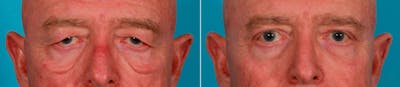 Eyelid Surgery (Blepharoplasty) Before & After Gallery - Patient 352426 - Image 1