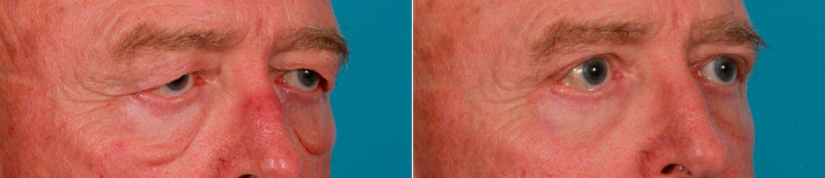 Eyelid Surgery (Blepharoplasty) Before & After Gallery - Patient 352426 - Image 2