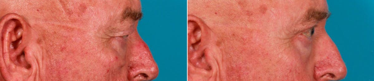 Eyelid Surgery (Blepharoplasty) Before & After Gallery - Patient 352426 - Image 3