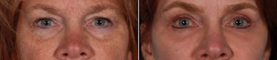 Eyelid Surgery (Blepharoplasty) Before & After Gallery - Patient 347928 - Image 1
