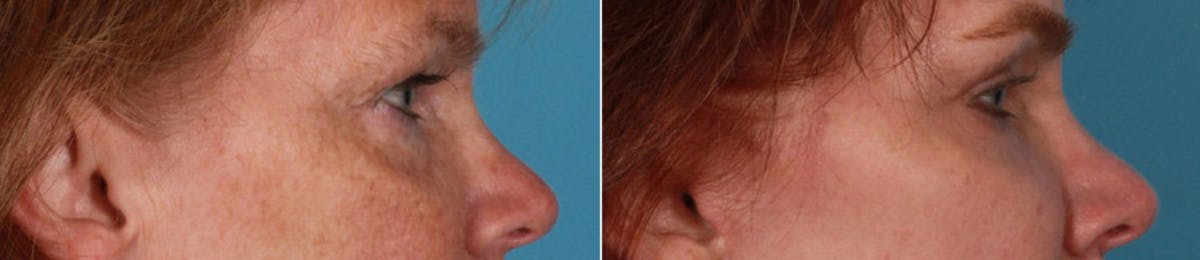 Eyelid Surgery (Blepharoplasty) Before & After Gallery - Patient 347928 - Image 3