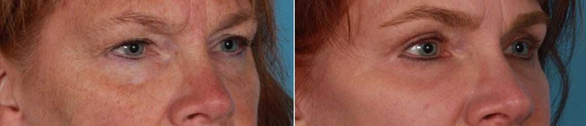 Eyelid Surgery (Blepharoplasty) Before & After Gallery - Patient 347928 - Image 2