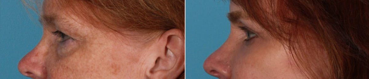 Eyelid Surgery (Blepharoplasty) Before & After Gallery - Patient 347928 - Image 4