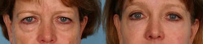 Eyelid Surgery (Blepharoplasty) Before & After Gallery - Patient 320731 - Image 1
