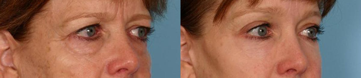 Eyelid Surgery (Blepharoplasty) Before & After Gallery - Patient 320731 - Image 2
