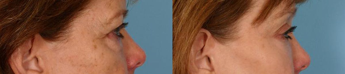 Eyelid Surgery (Blepharoplasty) Before & After Gallery - Patient 320731 - Image 3