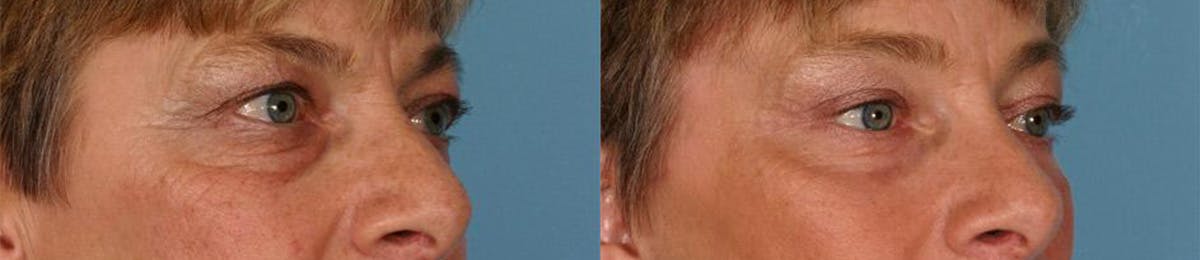 Eyelid Surgery (Blepharoplasty) Before & After Gallery - Patient 171903 - Image 2