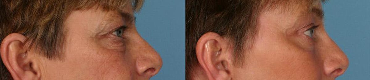 Eyelid Surgery (Blepharoplasty) Before & After Gallery - Patient 171903 - Image 3