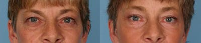 Eyelid Surgery (Blepharoplasty) Before & After Gallery - Patient 171903 - Image 1