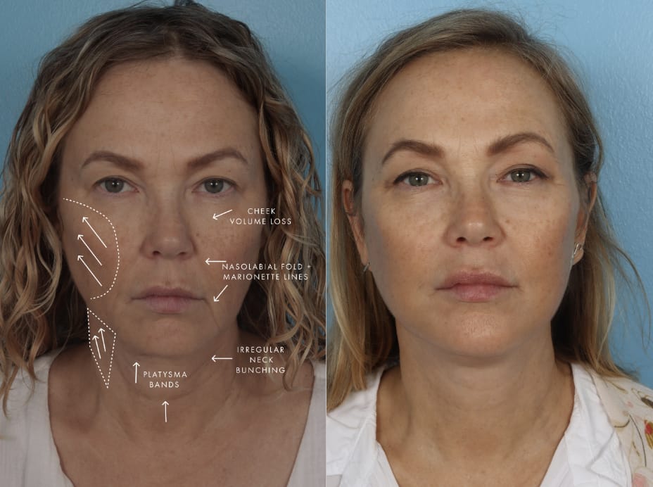 before and after facelift surgery inforgraphic
