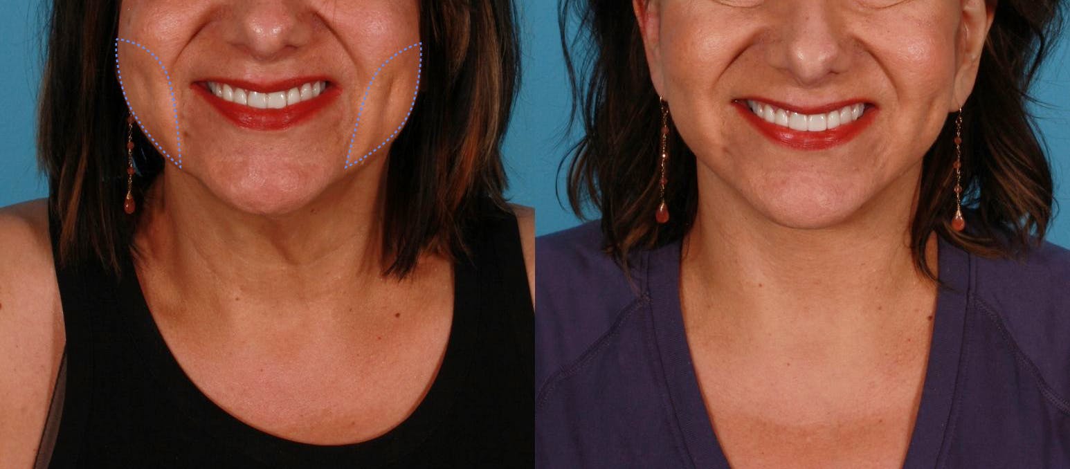before and after buccal fat removal