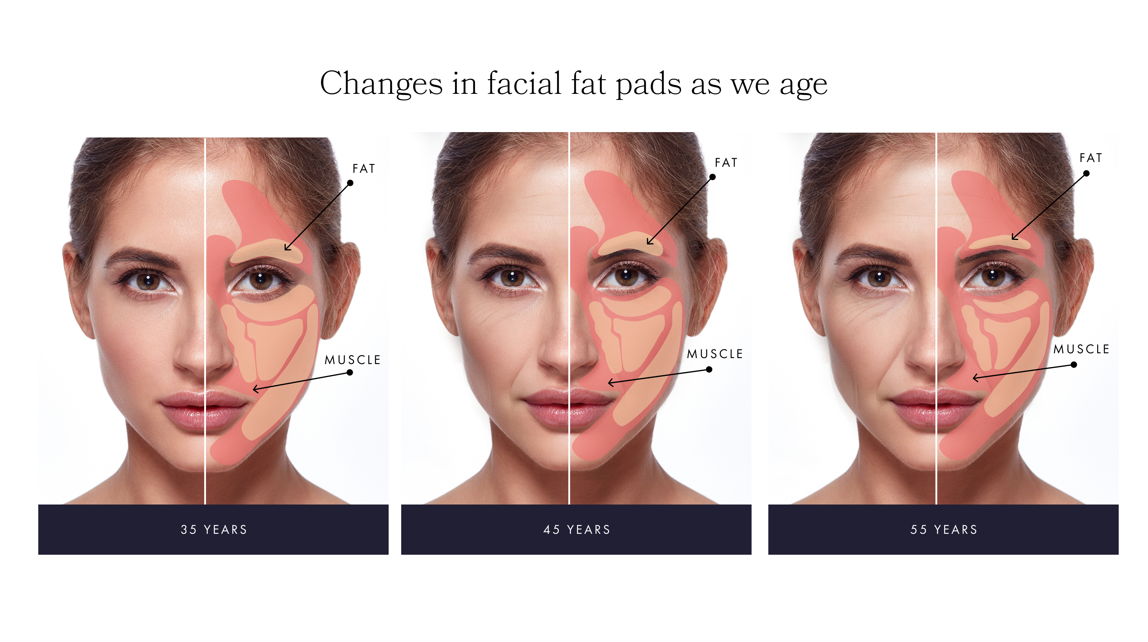 changes in facial fat pads as we age