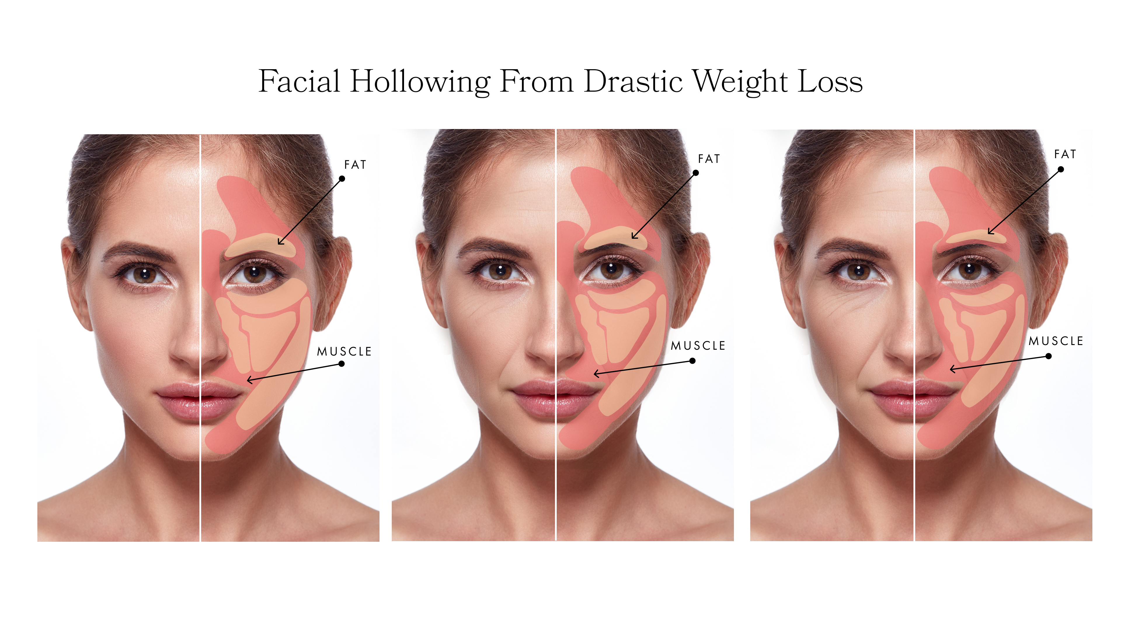 Facial hollowing from drastic weight loss infographic